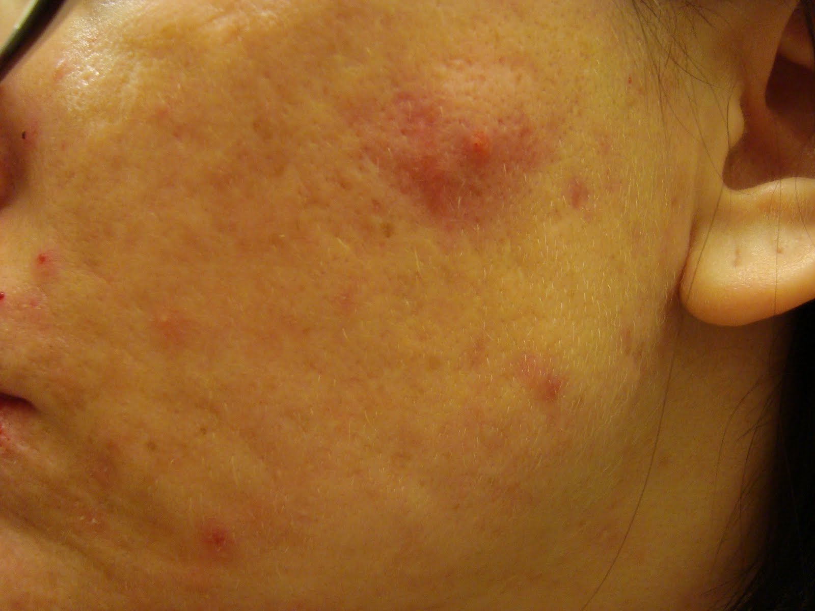 Accutane Rash Popular in Atopic Dermatitis / Eczema